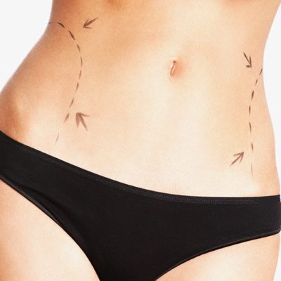 Body Contouring