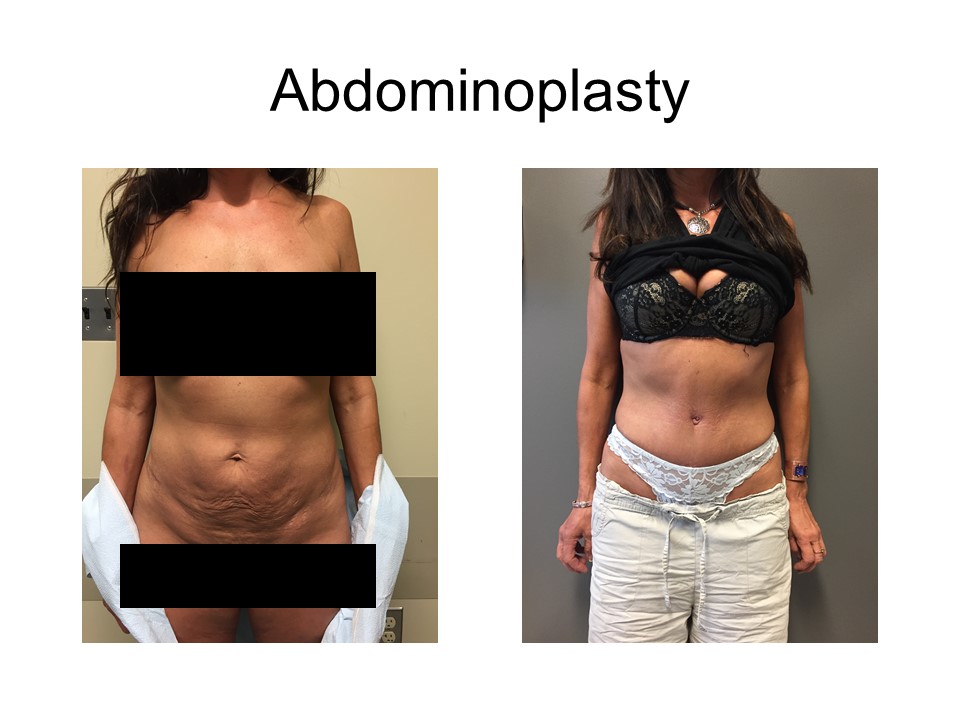 Abdominoplasty Khoury Plastic Surgery_IK